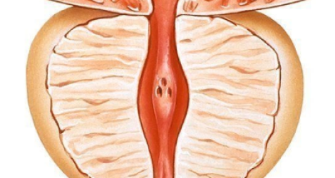  СИМПТОМЫ ПРИ АДЕНОМЕ ПРОСТАТЫ