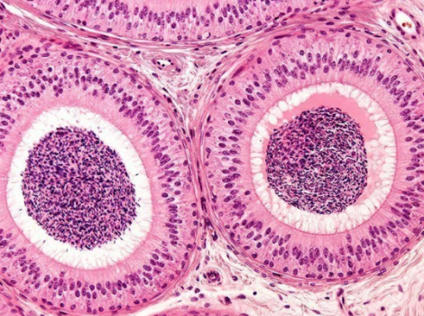  СИМПТОМЫ ПРИ ЭПИДИДИМИТЕ