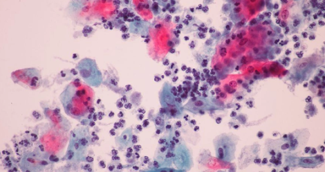 СИМПТОМЫ ПРИ ТРИХОМОНИАЗЕ