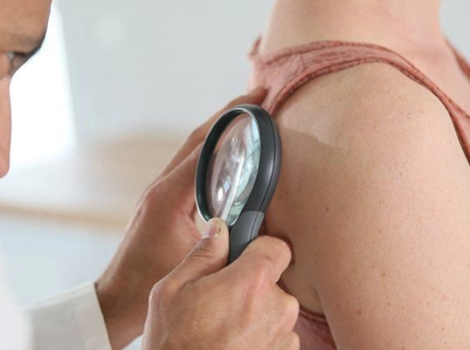  СИМПТОМЫ ПРИ ПСОРИАЗЕ