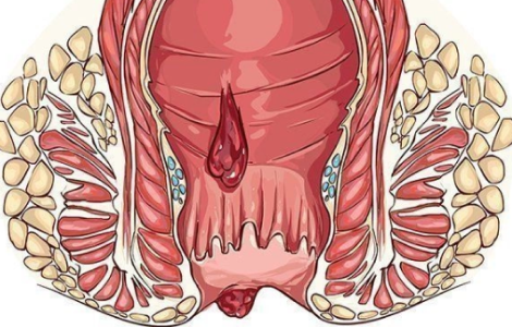  СИМПТОМЫ ПРИ ГЕМОРРОЕ